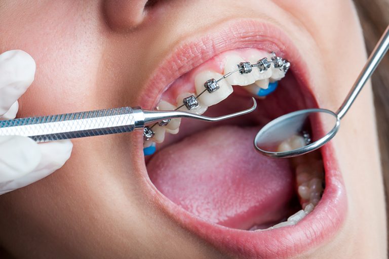 orthodontic-braces